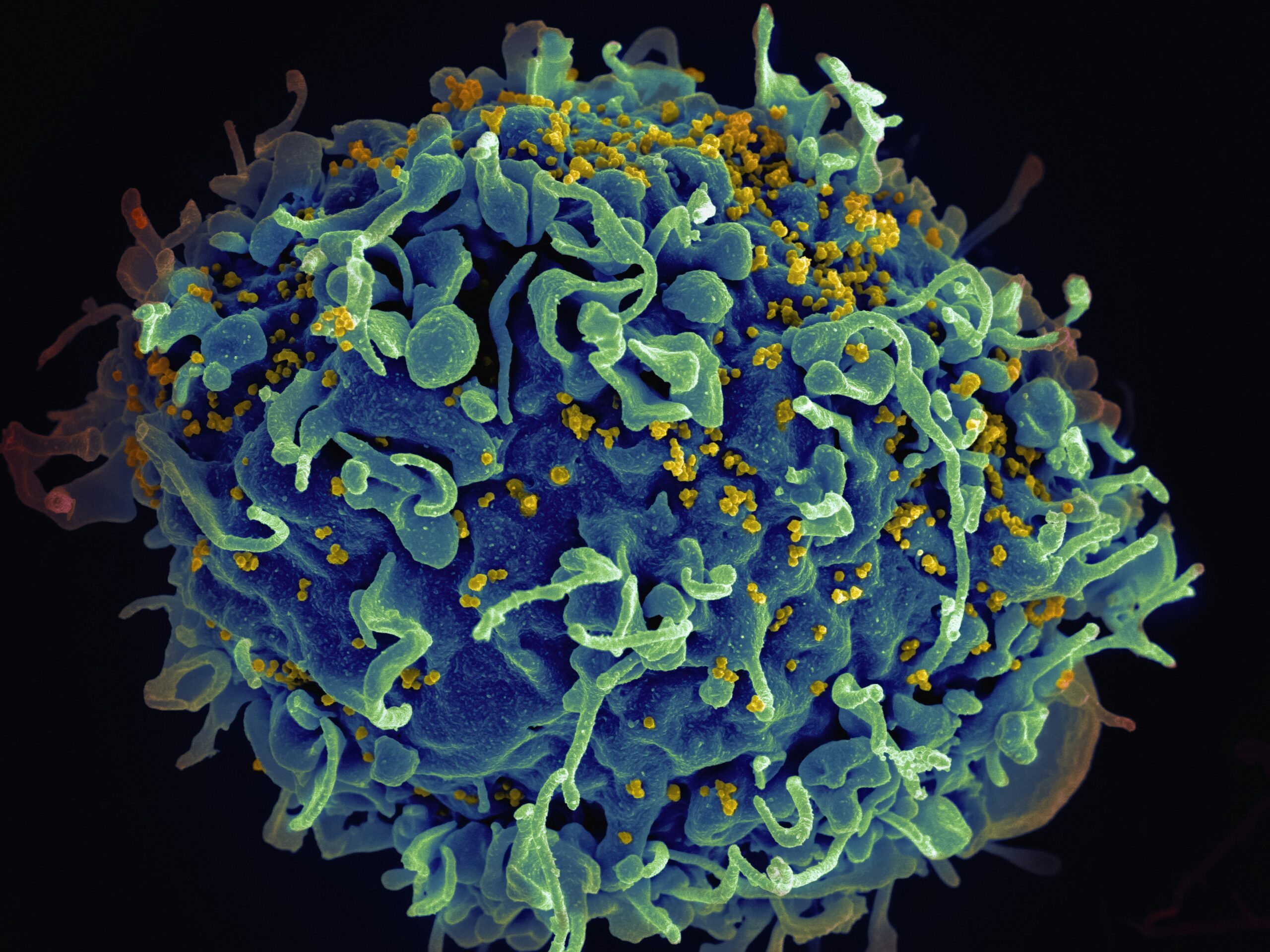 Recognizing Measles Symptoms in Adults Fever, cough, runny nose, sore throat, rash