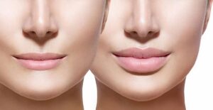 Lip Reducation Surgery : Transform Your Smile with Precision